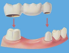 Root Canal In Upper East Side