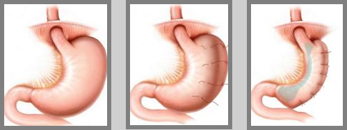 stomach wrap surgery image