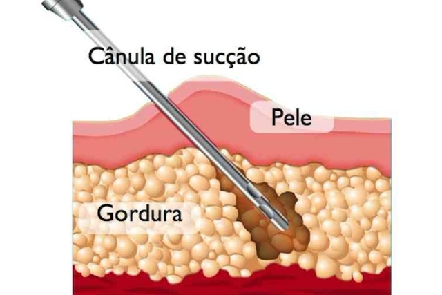 Lipoaspiração à laser em Jacarei - Aspirar gordura