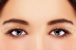 Cirurgia das pálpebras (blefaroplastia) em Jacareí -Palpebra superior