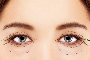 Cirurgia das pálpebras (blefaroplastia) em Jacareí-Papebra inferior