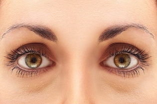 Cirurgia das pálpebras (blefaroplastia) em Jacareí-Antes da cirurgia
